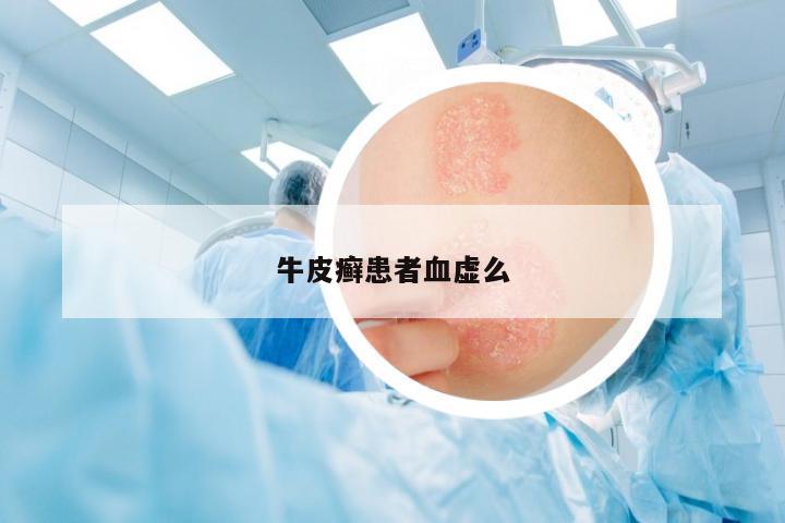 牛皮癬患者血虛么