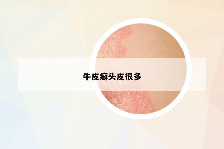 牛皮癬頭皮很多