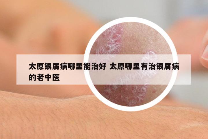太原銀屑病哪里能治好 太原哪里有治銀屑病的老中醫(yī)