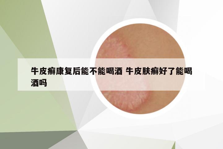 牛皮癬康復后能不能喝酒 牛皮膚癬好了能喝酒嗎
