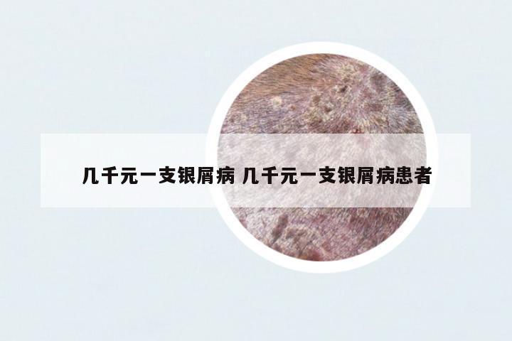 幾千元一支銀屑病 幾千元一支銀屑病患者