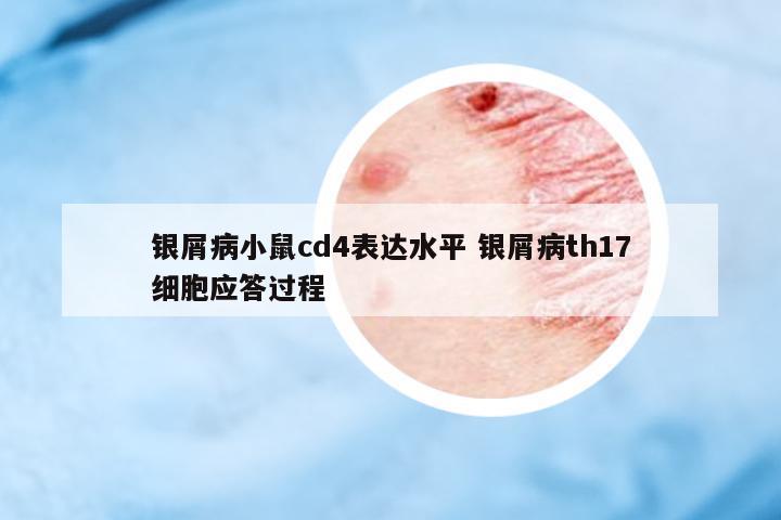 銀屑病小鼠cd4表達水平 銀屑病th17細胞應答過程
