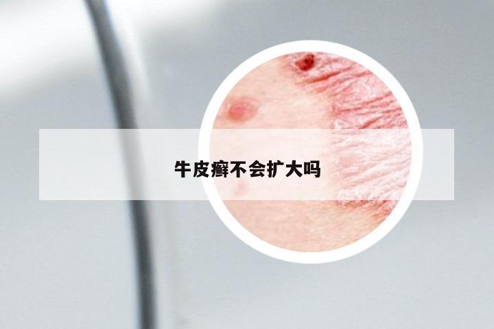 牛皮癬不會(huì)擴(kuò)大嗎