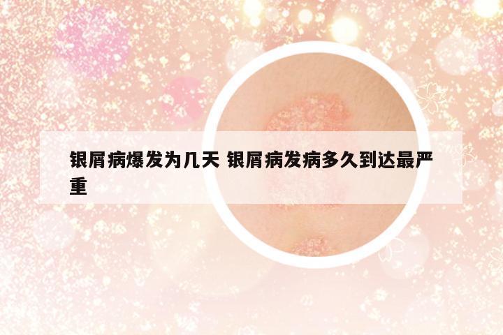 銀屑病爆發(fā)為幾天 銀屑病發(fā)病多久到達最嚴重