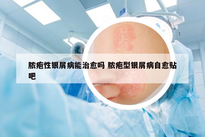 膿皰性銀屑病能治愈嗎 膿皰型銀屑病自愈貼吧