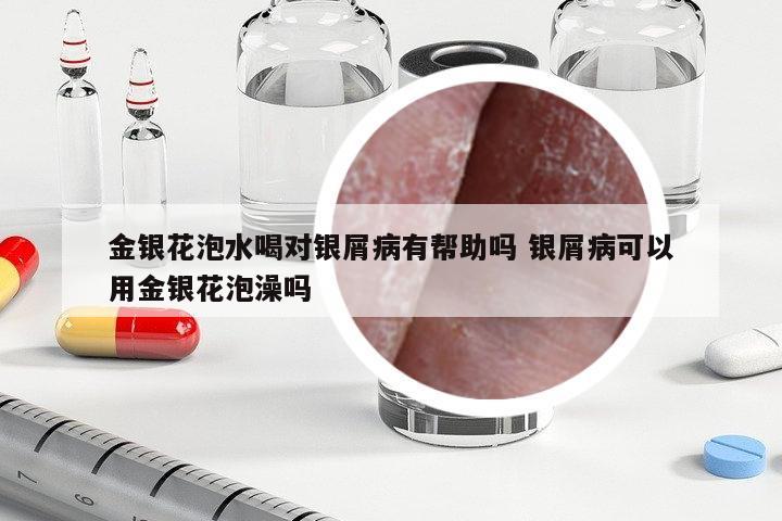 金銀花泡水喝對(duì)銀屑病有幫助嗎 銀屑病可以用金銀花泡澡嗎