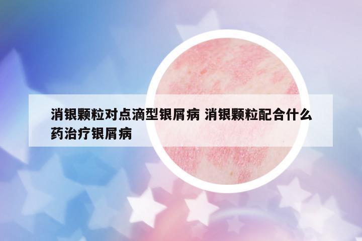 消銀顆粒對點(diǎn)滴型銀屑病 消銀顆粒配合什么藥治療銀屑病