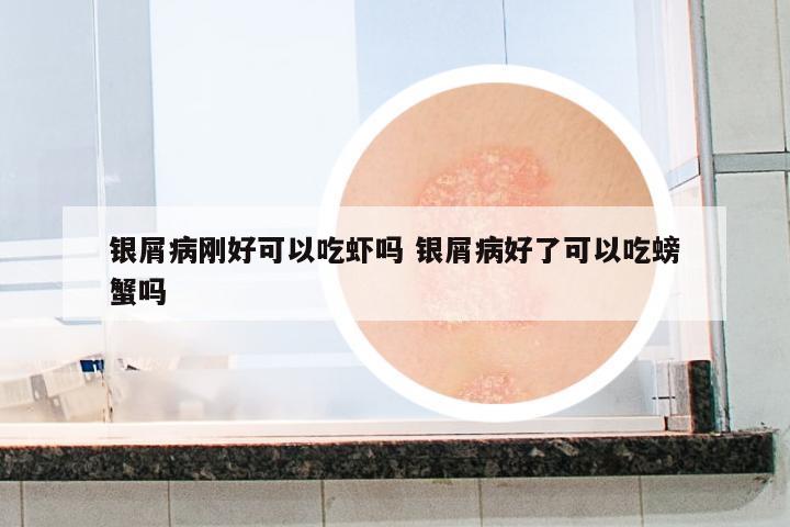 銀屑病剛好可以吃蝦嗎 銀屑病好了可以吃螃蟹嗎