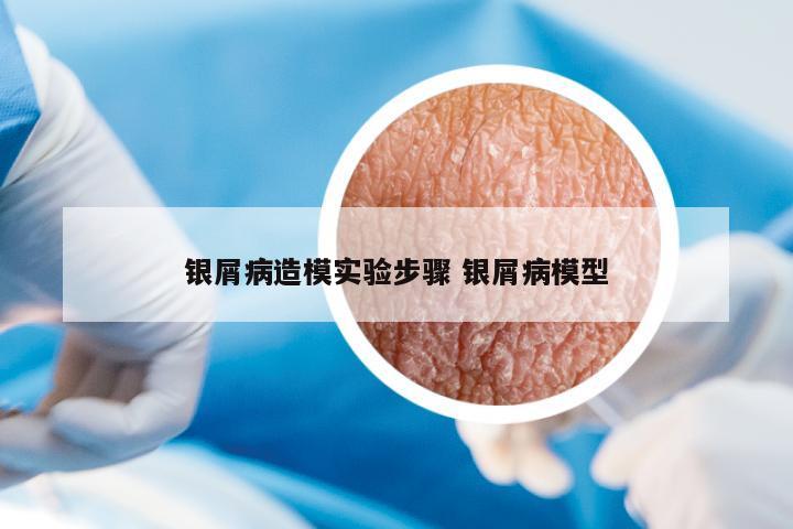 銀屑病造模實(shí)驗(yàn)步驟 銀屑病模型