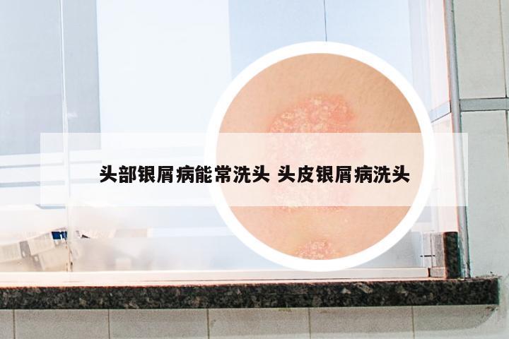頭部銀屑病能常洗頭 頭皮銀屑病洗頭