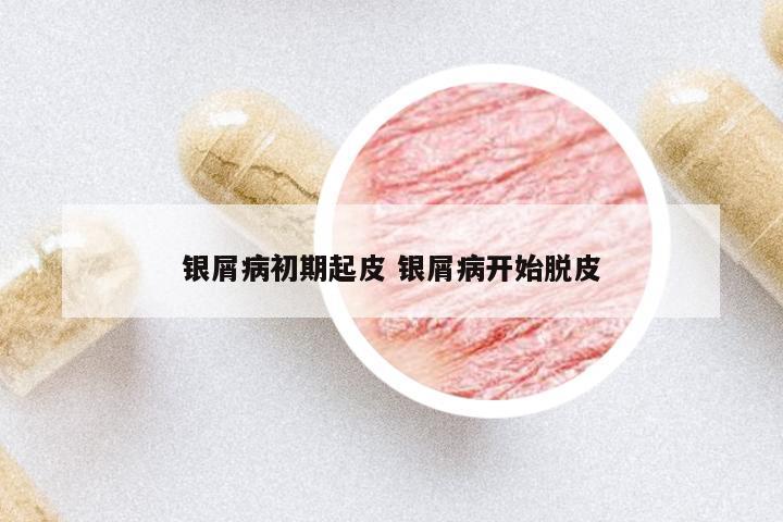 銀屑病初期起皮 銀屑病開(kāi)始脫皮