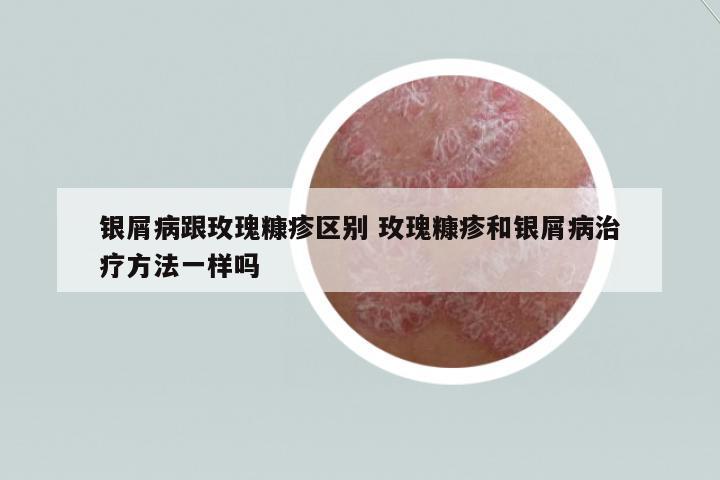 銀屑病跟玫瑰糠疹區(qū)別 玫瑰糠疹和銀屑病治療方法一樣嗎
