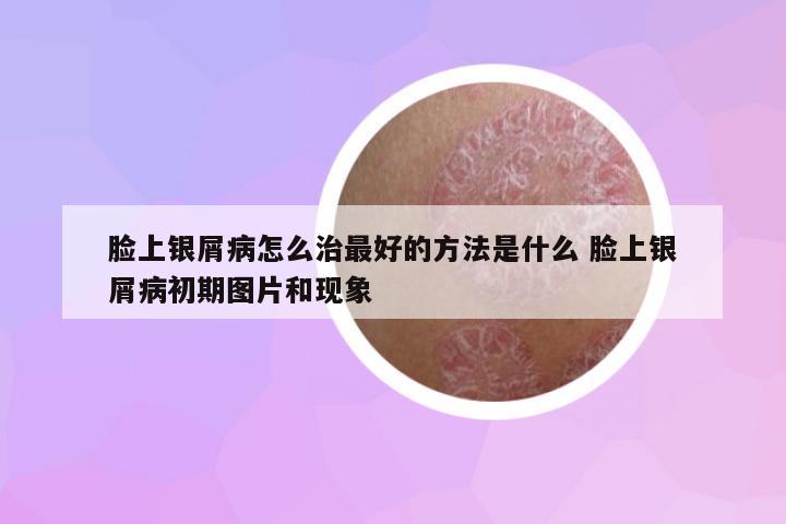 臉上銀屑病怎么治最好的方法是什么 臉上銀屑病初期圖片和現(xiàn)象