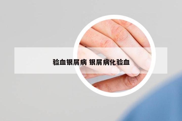 驗血銀屑病 銀屑病化驗血