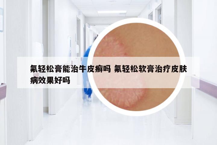 氟輕松膏能治牛皮癬嗎 氟輕松軟膏治療皮膚病效果好嗎