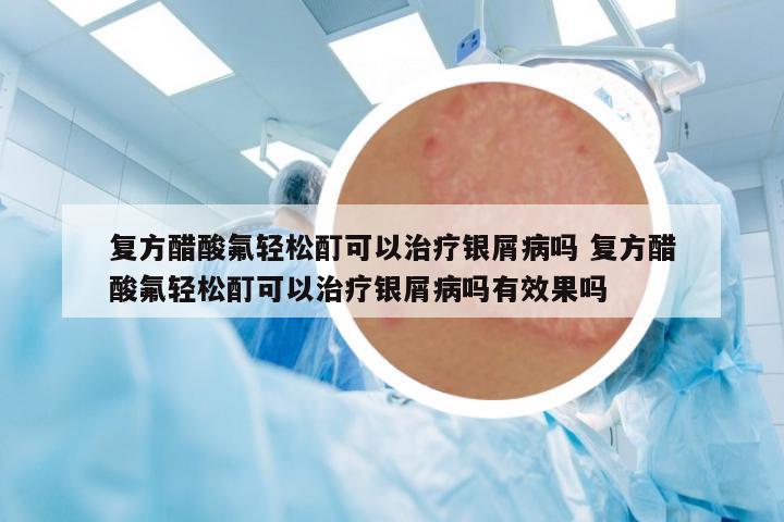 復(fù)方醋酸氟輕松酊可以治療銀屑病嗎 復(fù)方醋酸氟輕松酊可以治療銀屑病嗎有效果嗎
