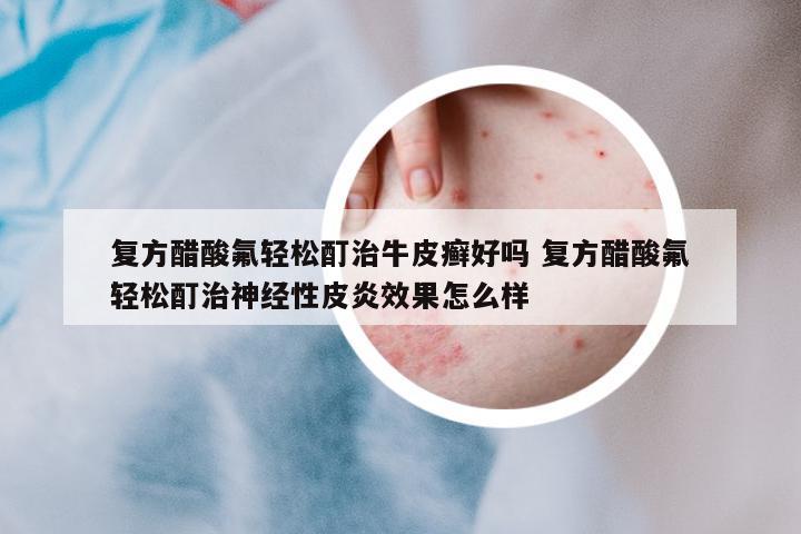 復(fù)方醋酸氟輕松酊治牛皮癬好嗎 復(fù)方醋酸氟輕松酊治神經(jīng)性皮炎效果怎么樣