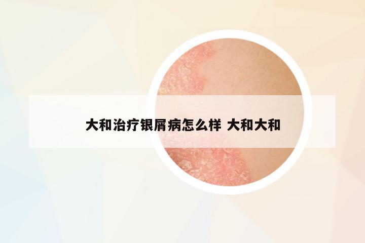 大和治療銀屑病怎么樣 大和大和