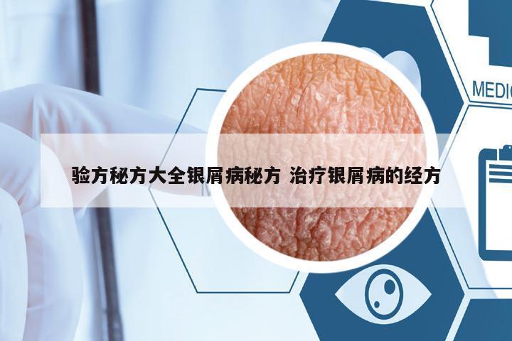 驗(yàn)方秘方大全銀屑病秘方 治療銀屑病的經(jīng)方