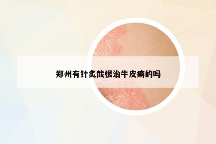 鄭州有針炙截根治牛皮癬的嗎