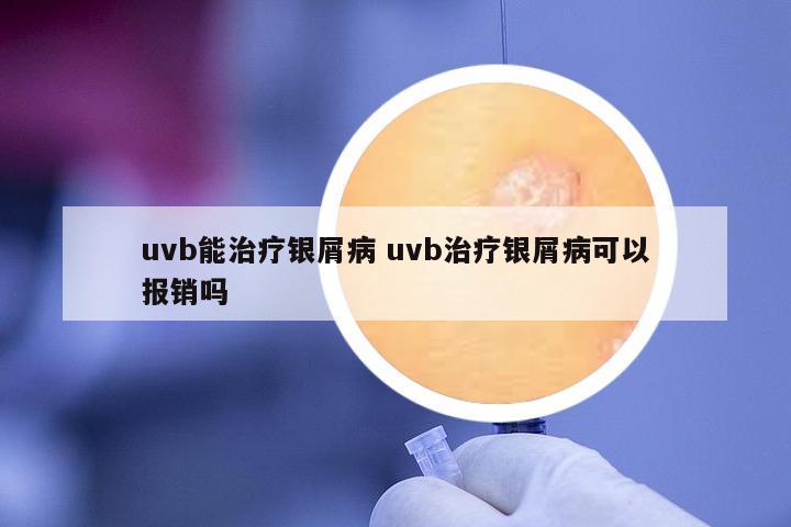 uvb能治療銀屑病 uvb治療銀屑病可以報(bào)銷嗎