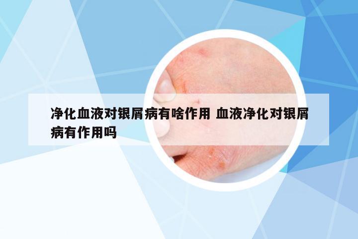凈化血液對銀屑病有啥作用 血液凈化對銀屑病有作用嗎