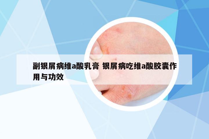 副銀屑病維a酸乳膏 銀屑病吃維a酸膠囊作用與功效