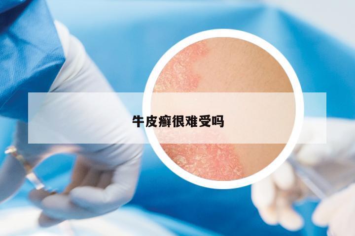 牛皮癬很難受嗎