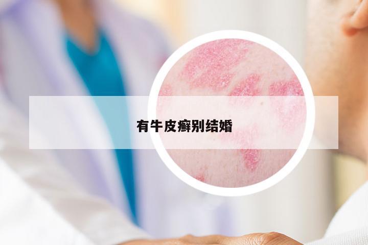 有牛皮癬別結(jié)婚