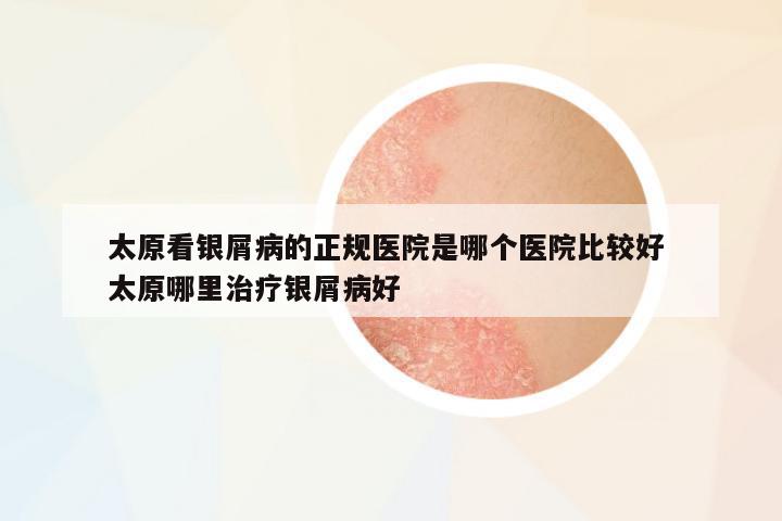 太原看銀屑病的正規(guī)醫(yī)院是哪個醫(yī)院比較好 太原哪里治療銀屑病好