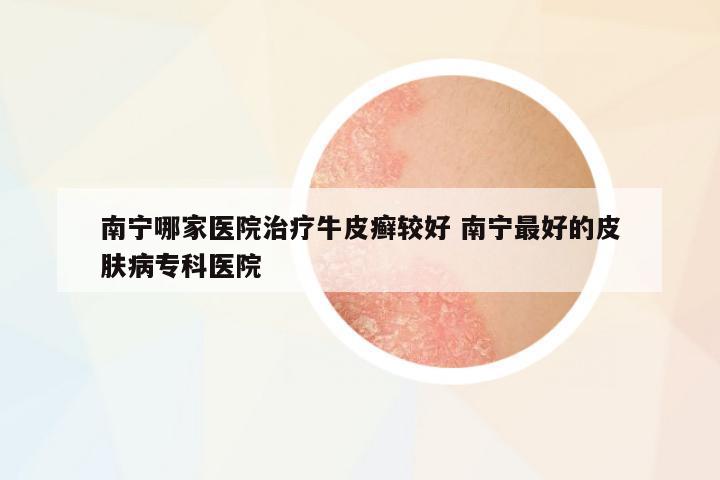南寧哪家醫(yī)院治療牛皮癬較好 南寧最好的皮膚病專科醫(yī)院