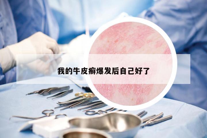 我的牛皮癬爆發(fā)后自己好了