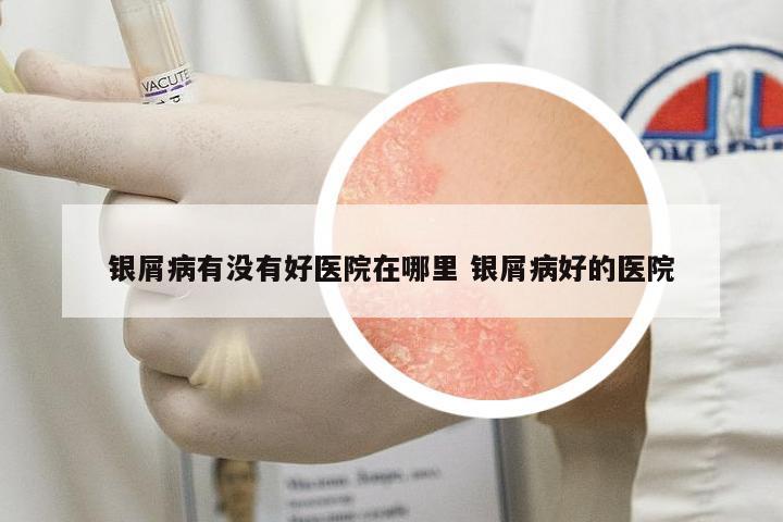 銀屑病有沒有好醫(yī)院在哪里 銀屑病好的醫(yī)院