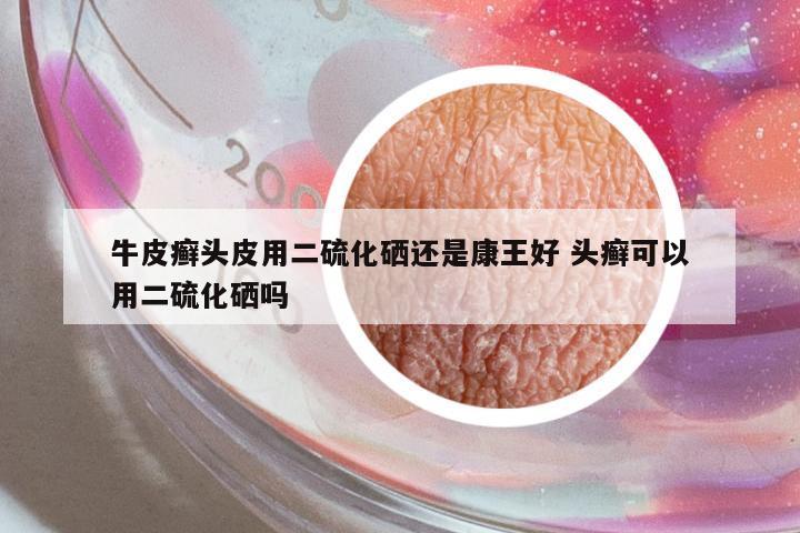 牛皮癬頭皮用二硫化硒還是康王好 頭癬可以用二硫化硒嗎