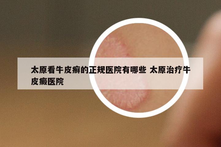 太原看牛皮癬的正規(guī)醫(yī)院有哪些 太原治療牛皮癜醫(yī)院