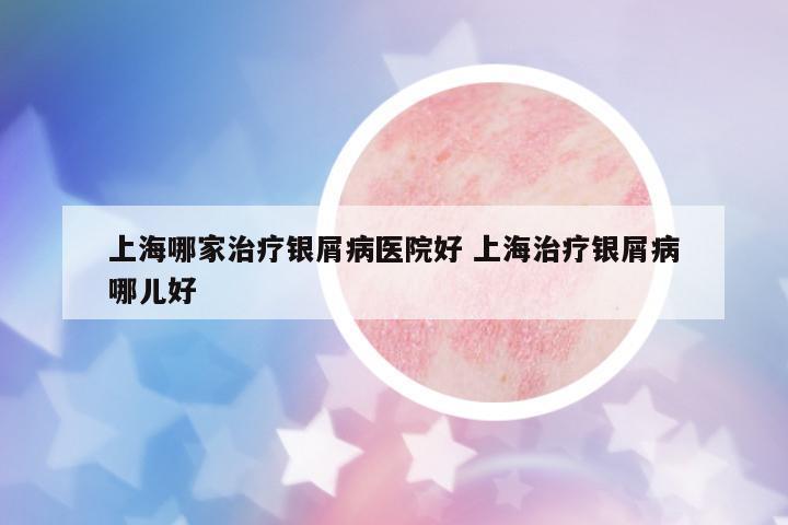 上海哪家治療銀屑病醫(yī)院好 上海治療銀屑病哪兒好
