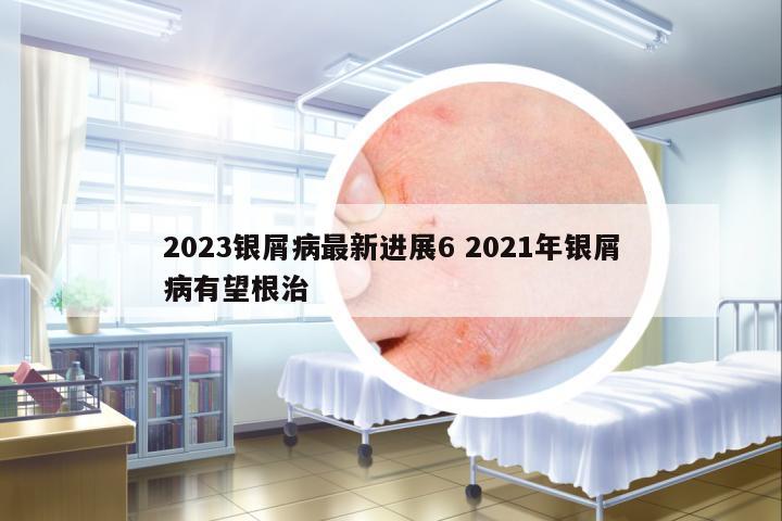 2023銀屑病最新進(jìn)展6 2021年銀屑病有望根治