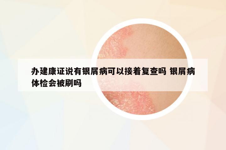 辦建康證說有銀屑病可以接著復(fù)查嗎 銀屑病體檢會(huì)被刷嗎