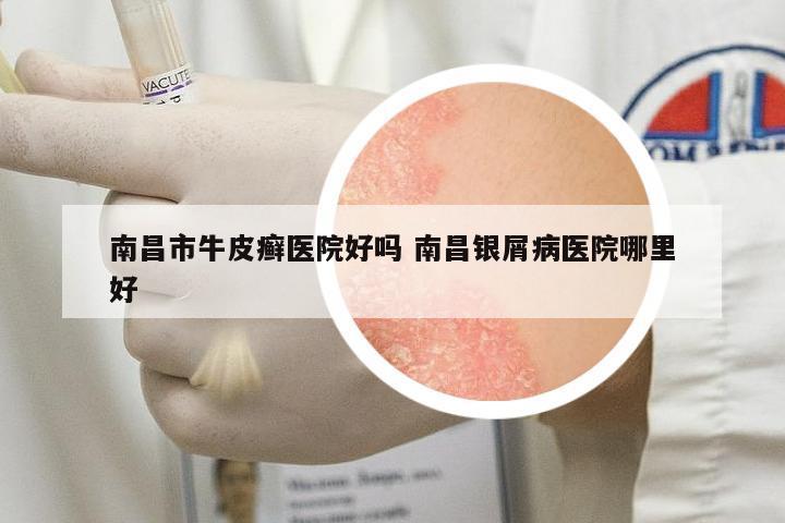 南昌市牛皮癬醫(yī)院好嗎 南昌銀屑病醫(yī)院哪里好