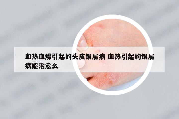 血熱血燥引起的頭皮銀屑病 血熱引起的銀屑病能治愈么