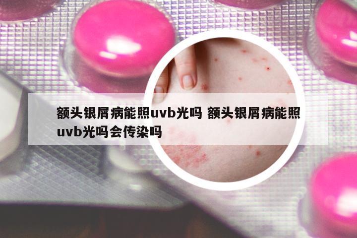 額頭銀屑病能照uvb光嗎 額頭銀屑病能照uvb光嗎會(huì)傳染嗎