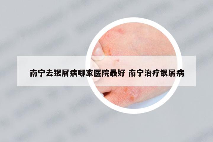南寧去銀屑病哪家醫(yī)院最好 南寧治療銀屑病