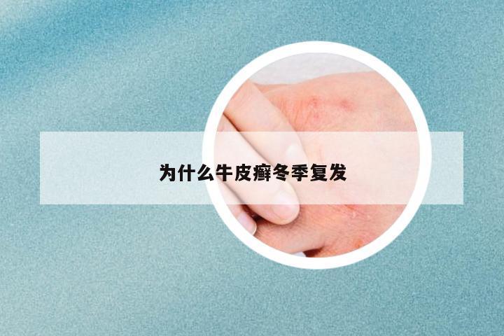 為什么牛皮癬冬季復(fù)發(fā)