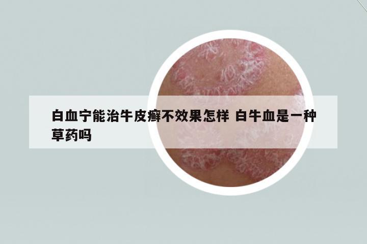 白血寧能治牛皮癬不效果怎樣 白牛血是一種草藥嗎