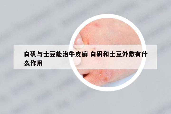 白礬與士豆能治牛皮癬 白礬和土豆外敷有什么作用