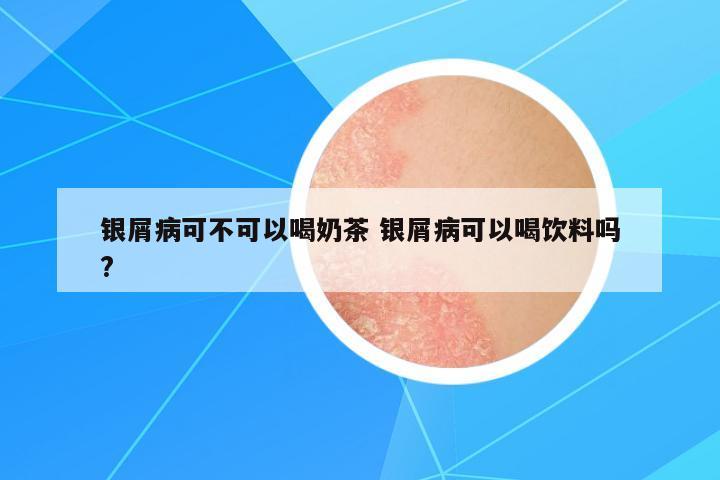 銀屑病可不可以喝奶茶 銀屑病可以喝飲料嗎?