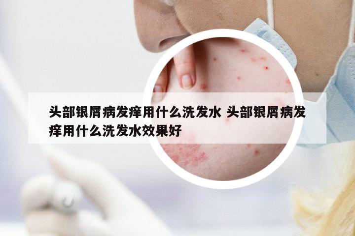 頭部銀屑病發(fā)癢用什么洗發(fā)水 頭部銀屑病發(fā)癢用什么洗發(fā)水效果好