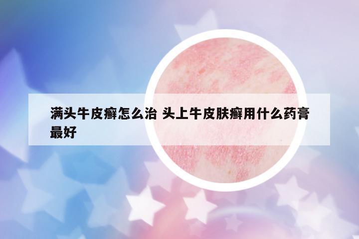 滿頭牛皮癬怎么治 頭上牛皮膚癬用什么藥膏最好