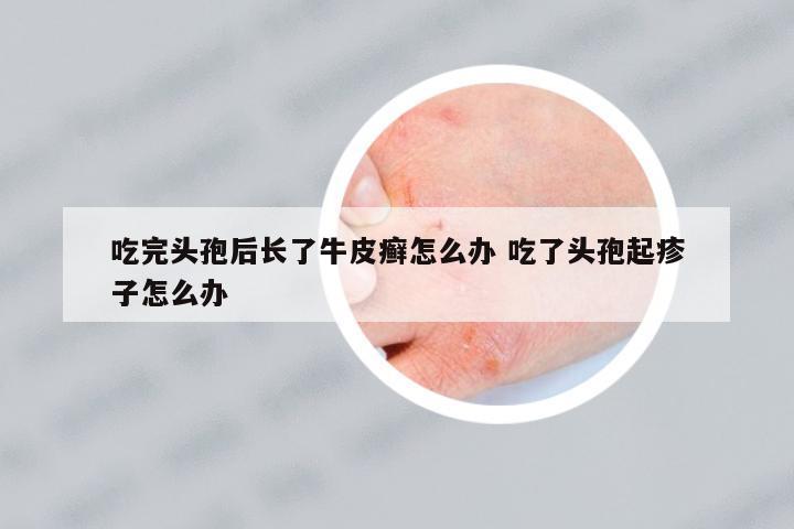 吃完頭孢后長了牛皮癬怎么辦 吃了頭孢起疹子怎么辦