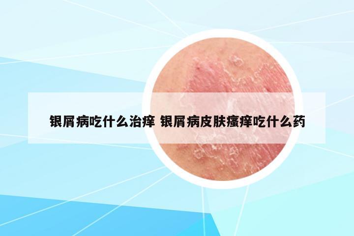 銀屑病吃什么治癢 銀屑病皮膚瘙癢吃什么藥